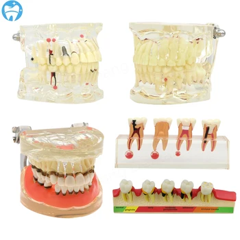 Стоматологическая патология Модель зубов со стандартным съемным стоматологическим обучением Образовательная модель для обучения практике стоматолога